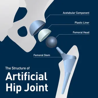 Hip Replacement Safety Alert: Another Stryker Hip Potentially Causing Metallosis and/or Requiring Revision