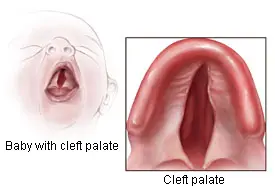 Ondansetron / Zofran Safety – Cleft Palate and Cleft Lip Injuries