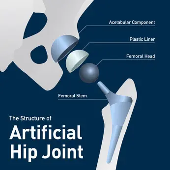 Hip-replacement-lawsuit-346x346-1