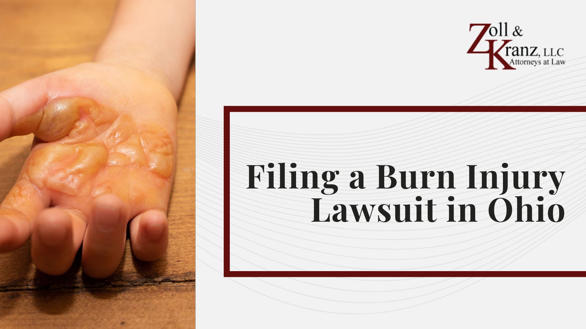 Filing a Burn Injury Lawsuit in Ohio; How Insurance Companies Handle Burn Injury Claims; Mistakes That Can Harm Your Burn Injury Claim; Steps Burn Injury Victims Should Take Immediately After an Accident; Calculating the Full Extent of Your Damages; Investigating Liability and Identifying At-Fault Parties; How Our Toledo Burn Injury Attorneys Build Strong Cases; Understanding Burn Injury Claims in Toledo, Ohio; Common Types of Burn Injury Cases We Handle
